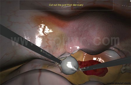卵巢囊肿切除术模拟系统
