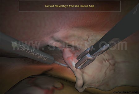 异位妊娠切除术模拟系统